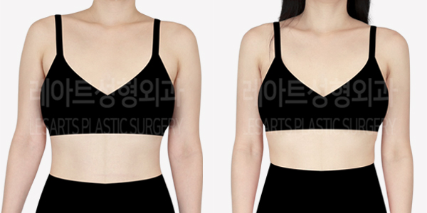 arm_liposuction_01_thumbnail_240531