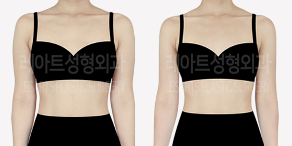 arm_liposuction_01_thumbnail_240611