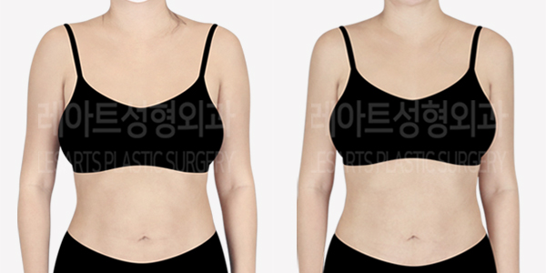 arm_liposuction_01_thumbnail_240617