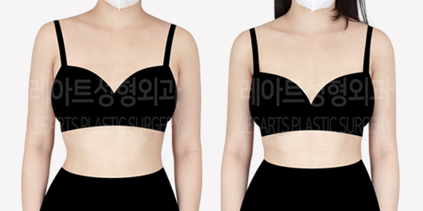 arm_liposuction_01_thumbnail_240625