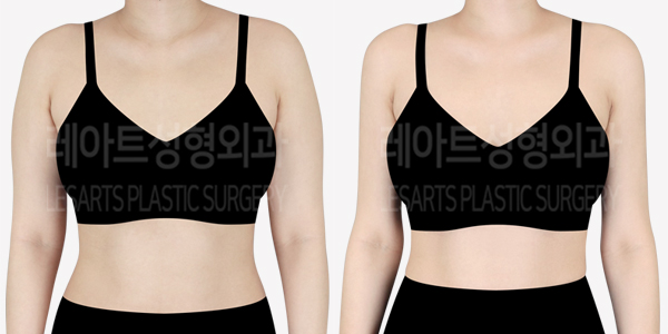arm_liposuction_01_thumbnail_240705