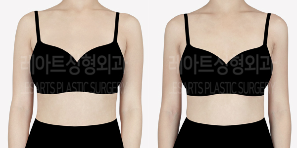 arm_liposuction_01_thumbnail_240709