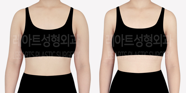 arm_liposuction_01_thumbnail_240712