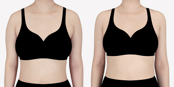 arm_liposuction_01_thumbnail_240723