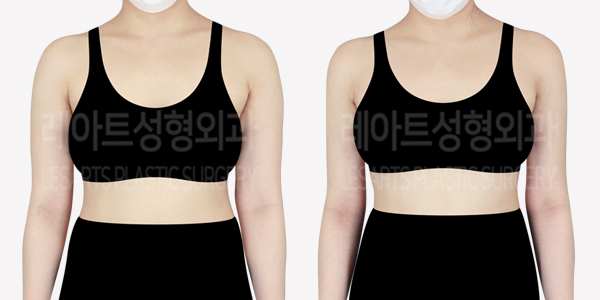 arm_liposuction_01_thumbnail_240725