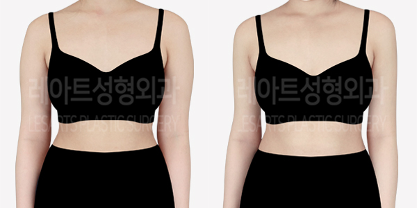 arm_liposuction_01_thumbnail_240729
