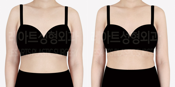 arm_liposuction_01_thumbnail_240731