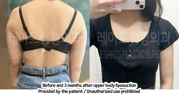 arm_liposuction_02_01_231226