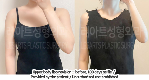 arm_liposuction_02_01_240105