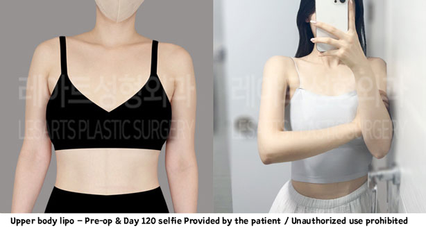 arm_liposuction_02_01_240111