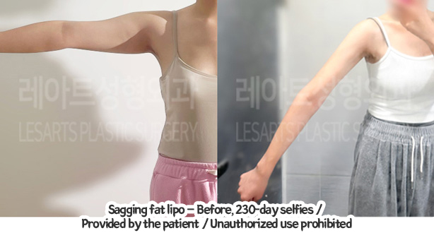 arm_liposuction_02_01_240129