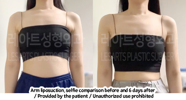 arm_liposuction_02_01_240208