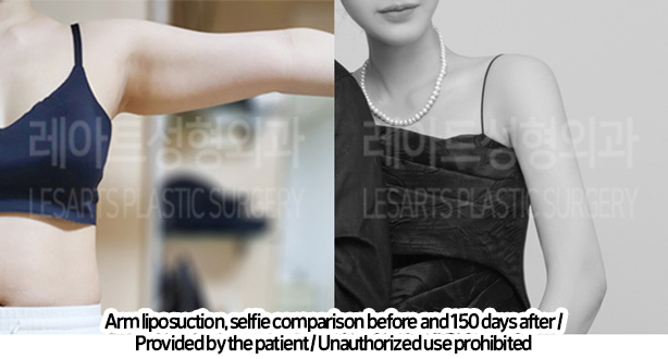 arm_liposuction_02_01_240219_2