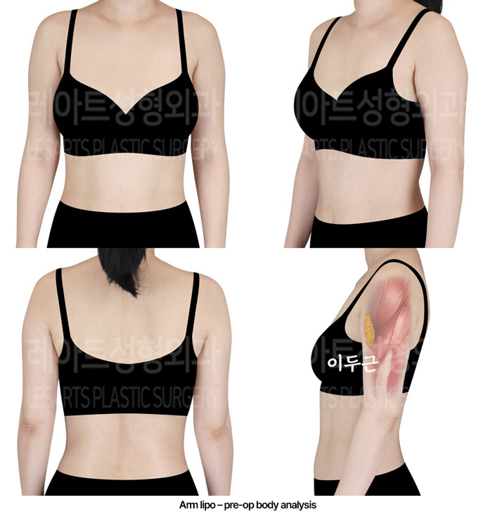 arm_liposuction_02_01_240229