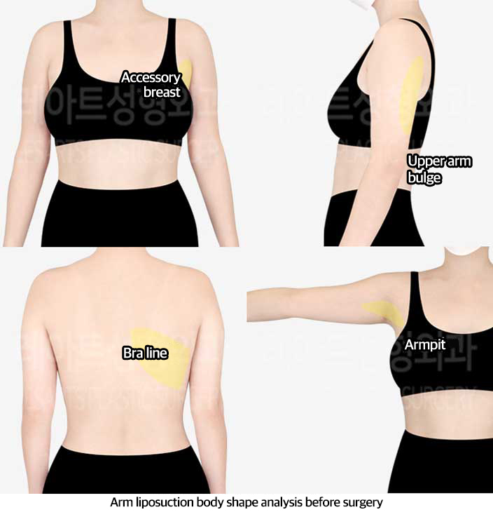 arm_liposuction_02_01_240326
