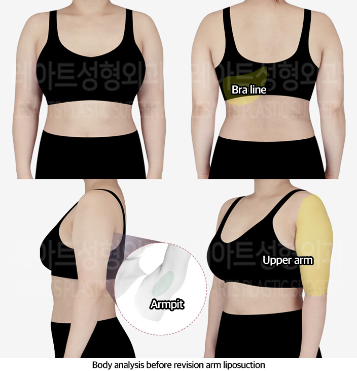 arm_liposuction_02_01_240401