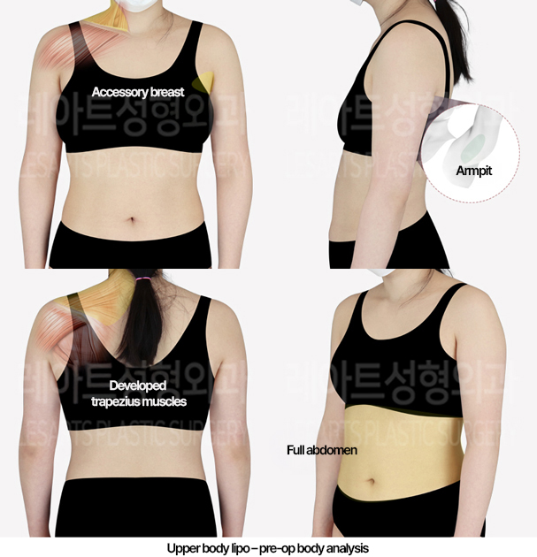 arm_liposuction_02_01_240509