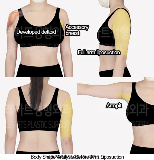 arm_liposuction_02_01_240520