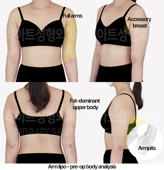 arm_liposuction_02_01_240527