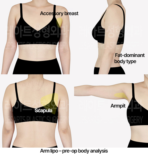 arm_liposuction_02_01_240531