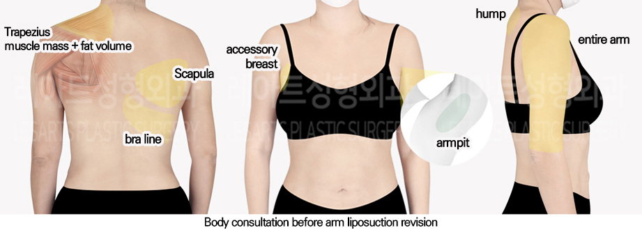 arm_liposuction_02_01_240617