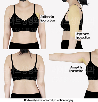 arm_liposuction_02_01_240705