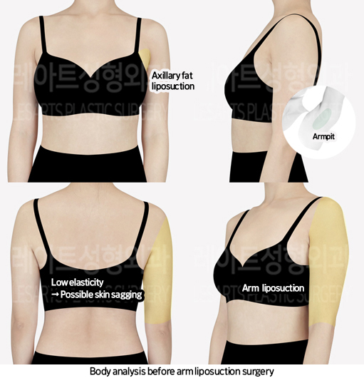 arm_liposuction_02_01_240709