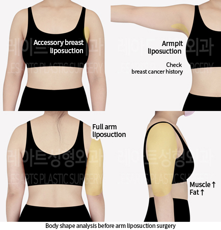 arm_liposuction_02_01_240712