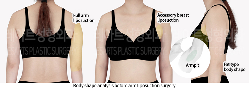 arm_liposuction_02_01_240723