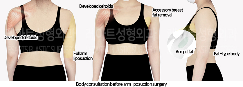 arm_liposuction_02_01_240725