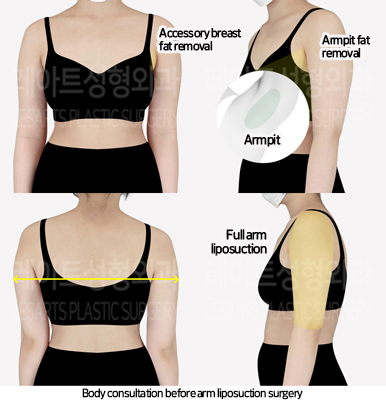 arm_liposuction_02_01_240729