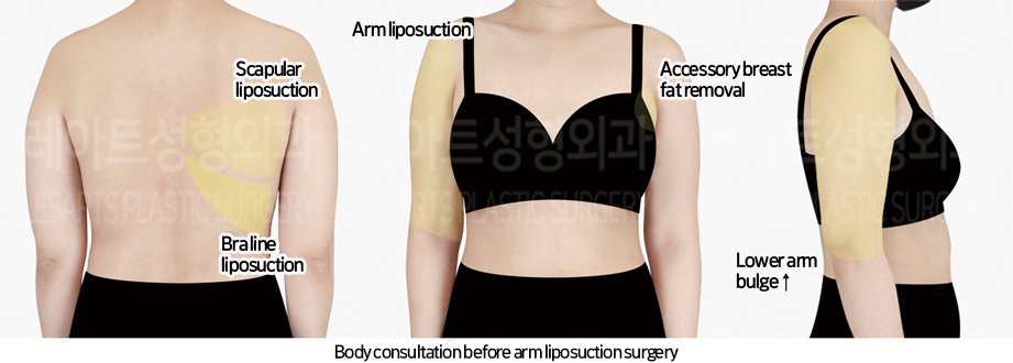 arm_liposuction_02_01_240731