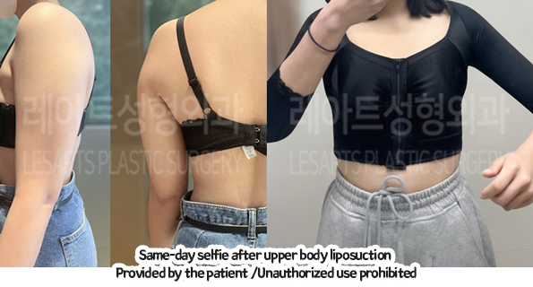arm_liposuction_02_02_231226