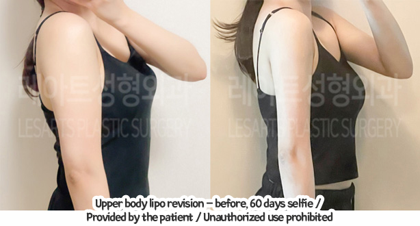 arm_liposuction_02_02_240105