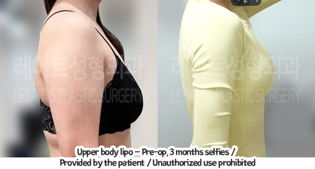 arm_liposuction_02_02_240117