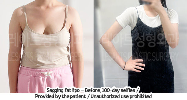 arm_liposuction_02_02_240129
