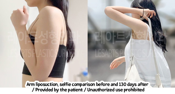 arm_liposuction_02_02_240208