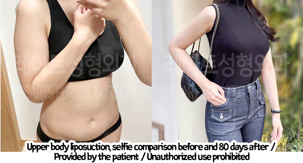 arm_liposuction_02_02_240219