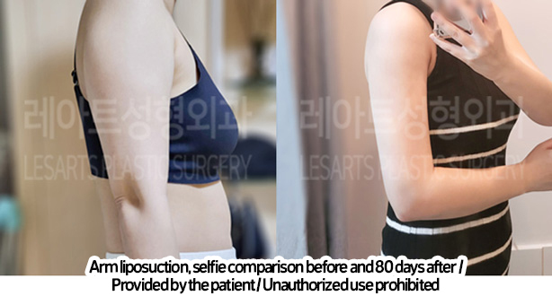 arm_liposuction_02_02_240219_2