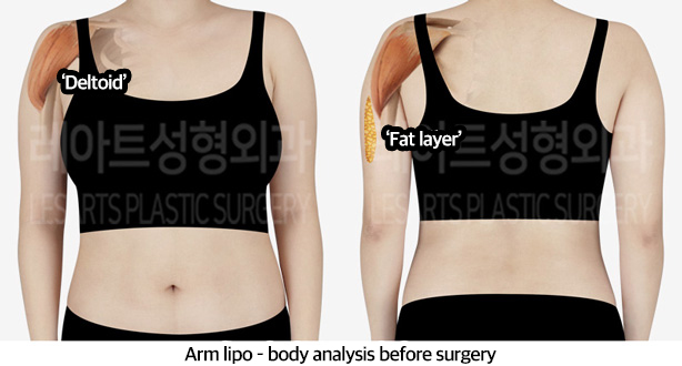 arm_liposuction_02_02_240223