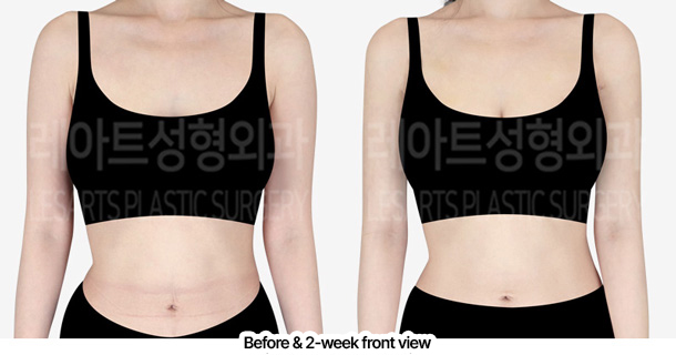 arm_liposuction_02_02_240228