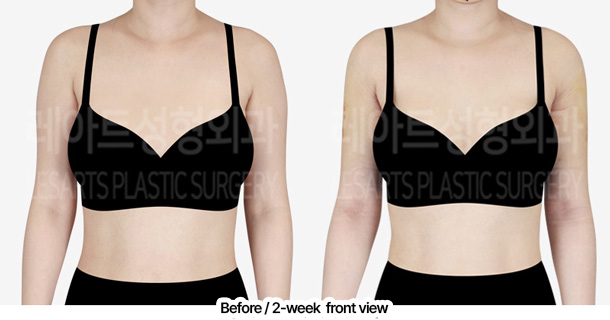 arm_liposuction_02_02_240229
