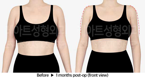 arm_liposuction_02_02_240326
