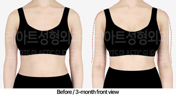 arm_liposuction_02_02_240422