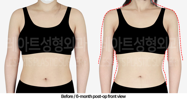 arm_liposuction_02_02_240509
