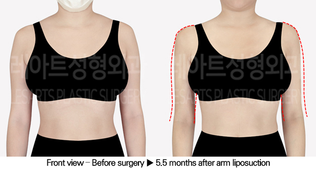 arm_liposuction_02_02_240520
