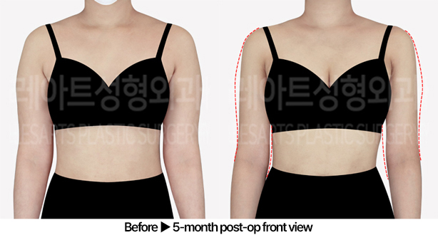 arm_liposuction_02_02_240527
