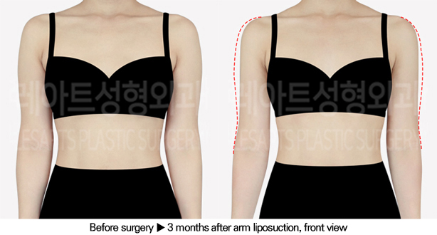 arm_liposuction_02_02_240611