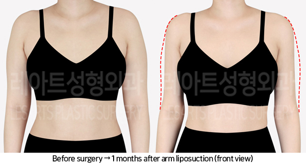 arm_liposuction_02_02_240705