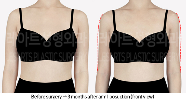 arm_liposuction_02_02_240709